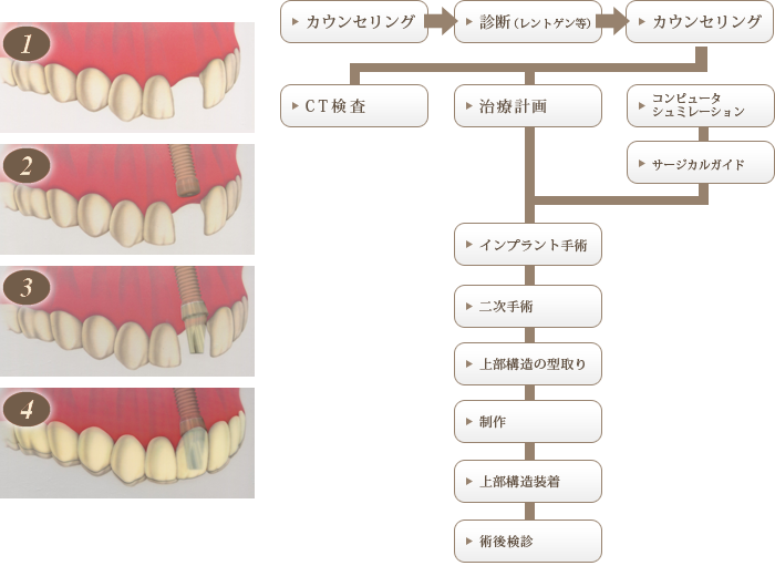 インプラントとは